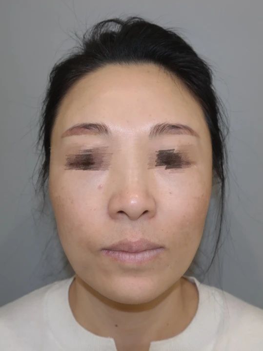 重获新生的惊艳转变！看43岁女美人如何通过拉皮手术反转人生！