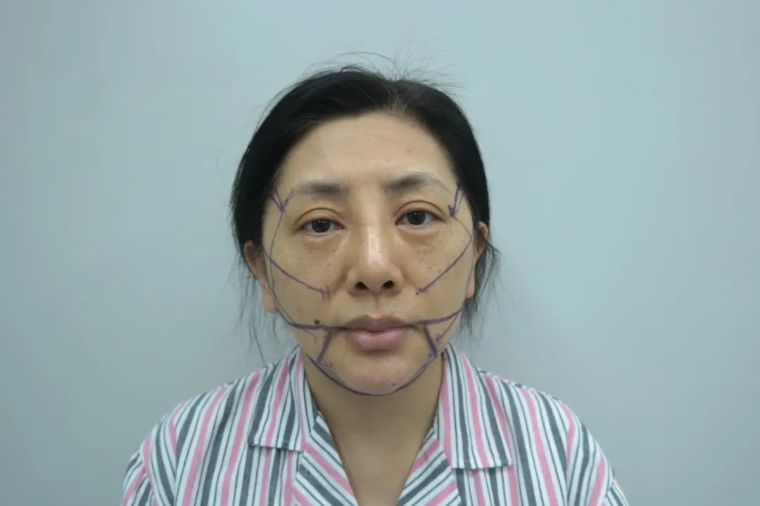 拉皮手术恐怖吗？旧的不去，新的不来，49岁直面拉皮手术，效果太惊艳了！