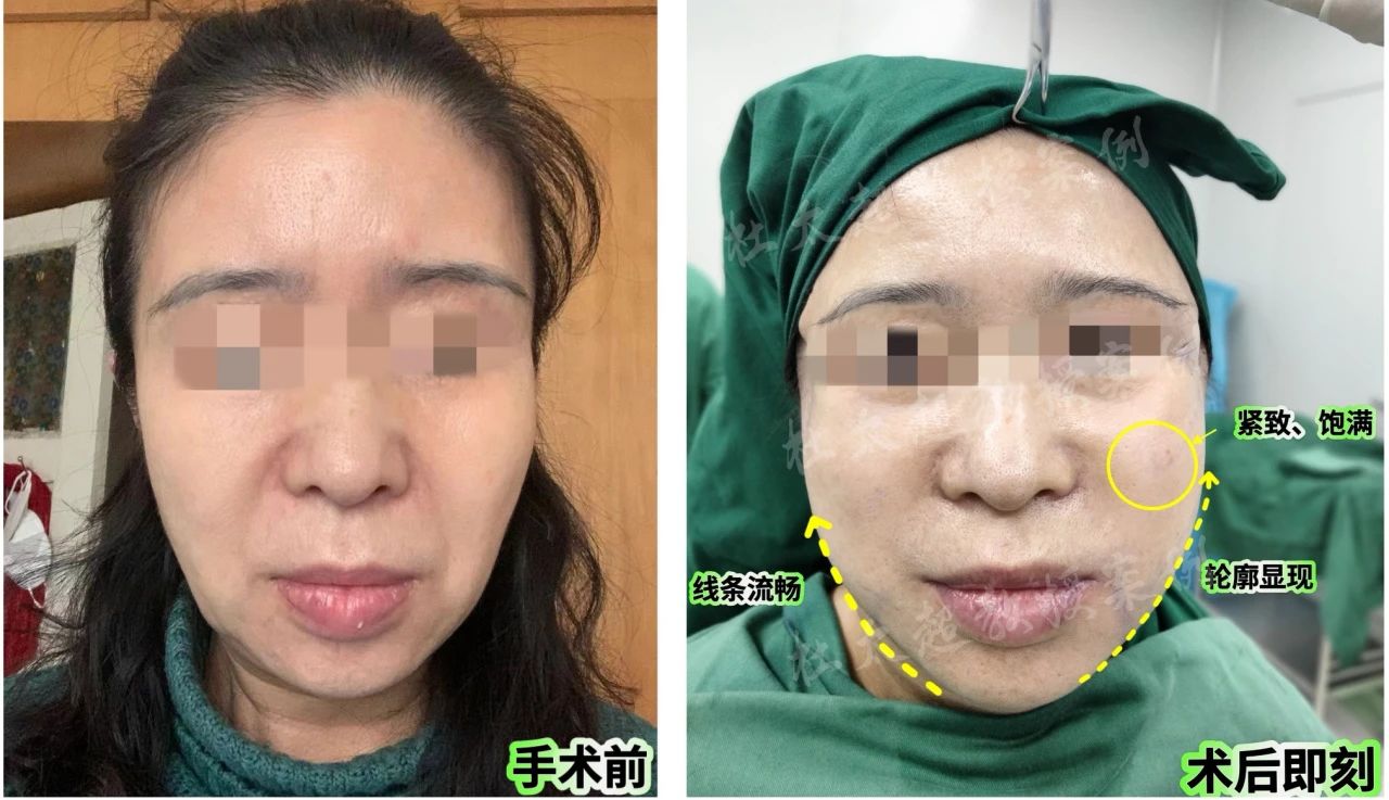 56岁女性的拉皮手术体验分享，惊叹效果超越预期！