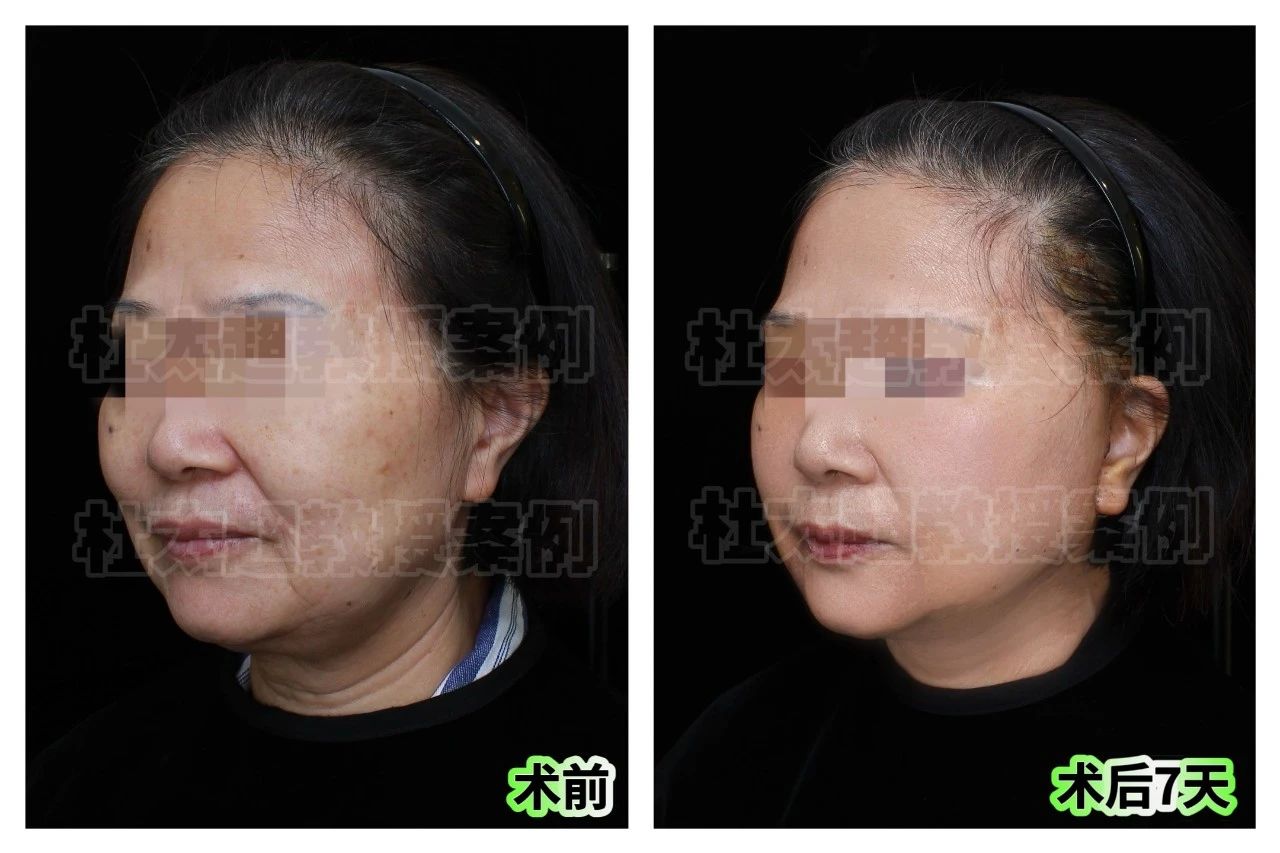 拉皮手术全过程大曝光！60岁不听劝阻叛逆寻回青春，效果惊为天人！