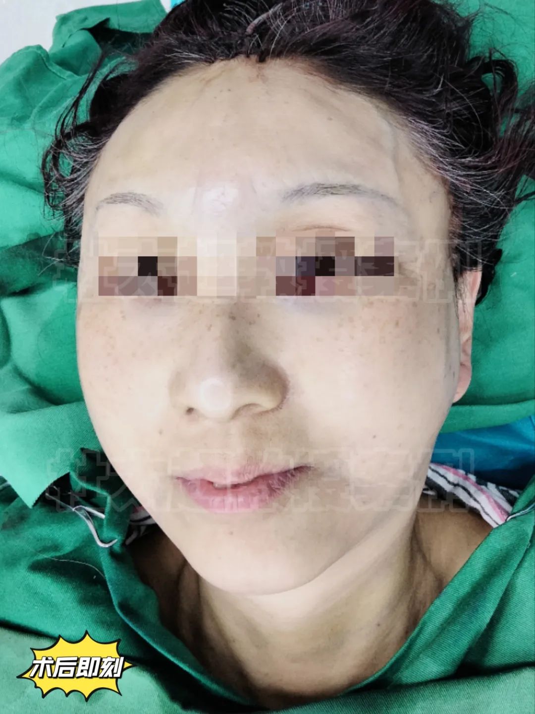 拉皮手术效果这么惊艳吗？55岁女士直呼我不敢相信这是我自己！