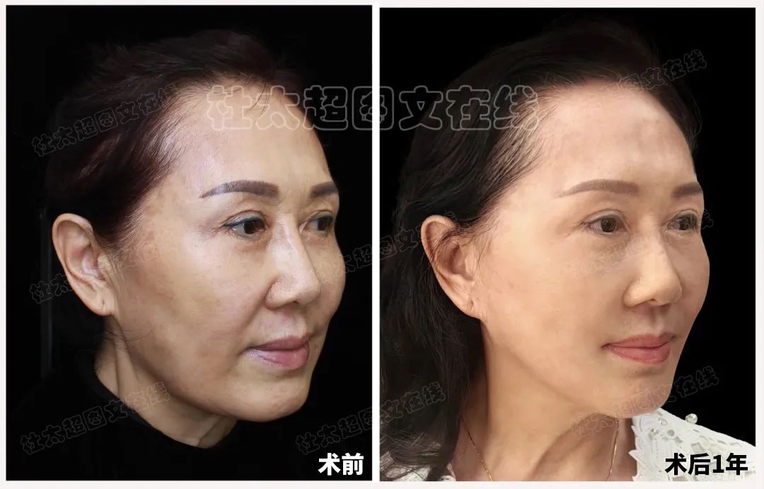 60岁爱美者一年后的深情告白！这个拉皮手术让我太意外了！