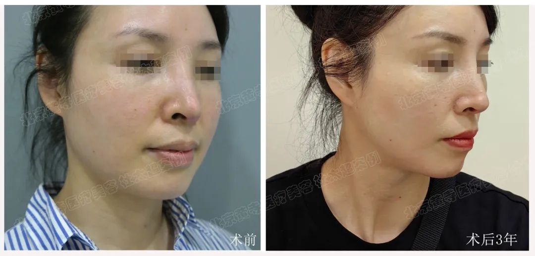 44岁女士做了拉皮手术，术后三年效果让人惊讶不已！他们都不敢相信！