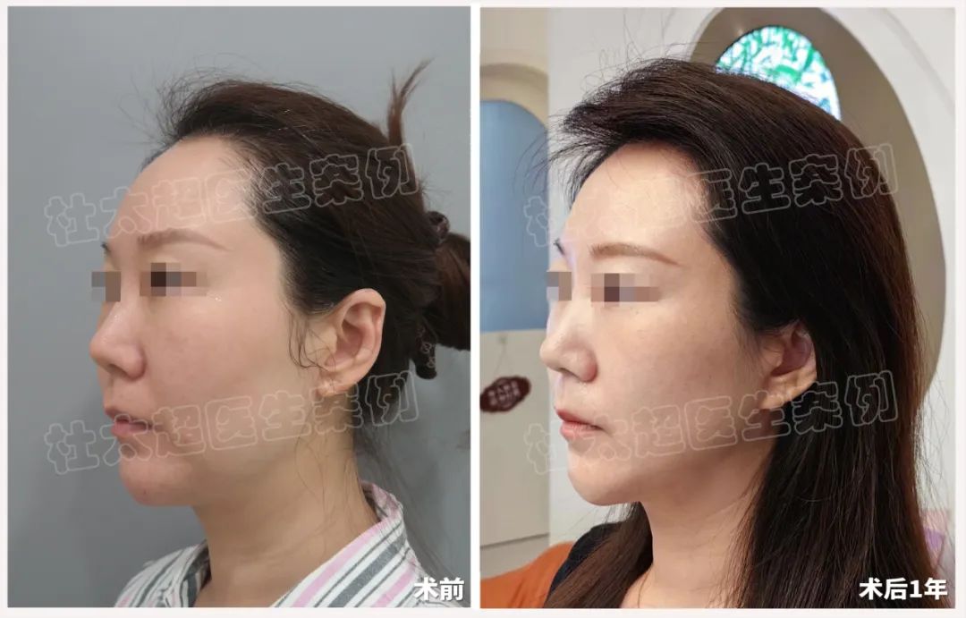 效果令人惊艳！历经25年再一次选择走进黄寺医院，接受拉皮手术。