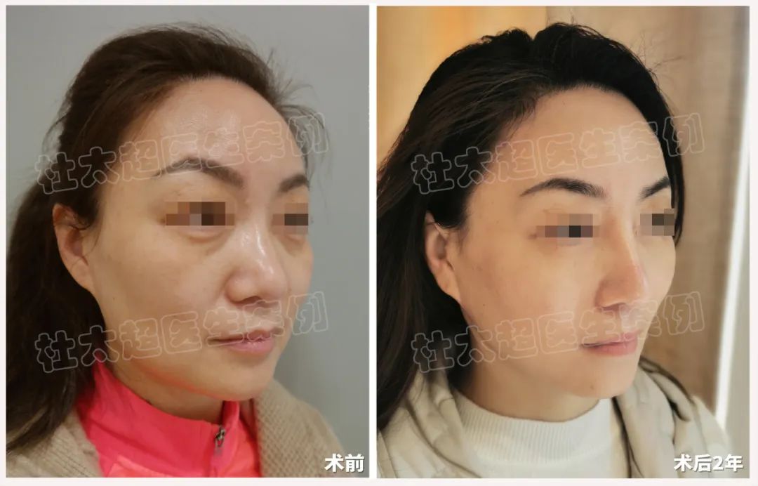拉皮手术太不可思议了！49岁女性逆生长神话，50还能如40般盛放青春！