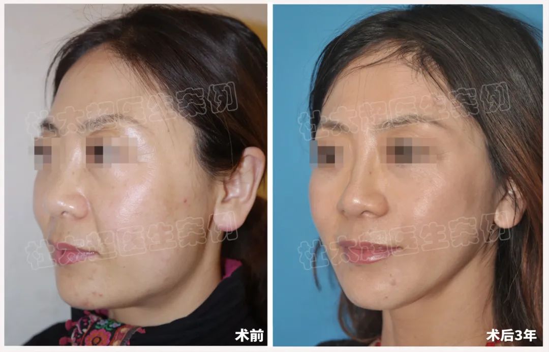 化妆品的假象还是实打实的年轻改变？——48岁求美者拉皮手术术后三年效果对比！