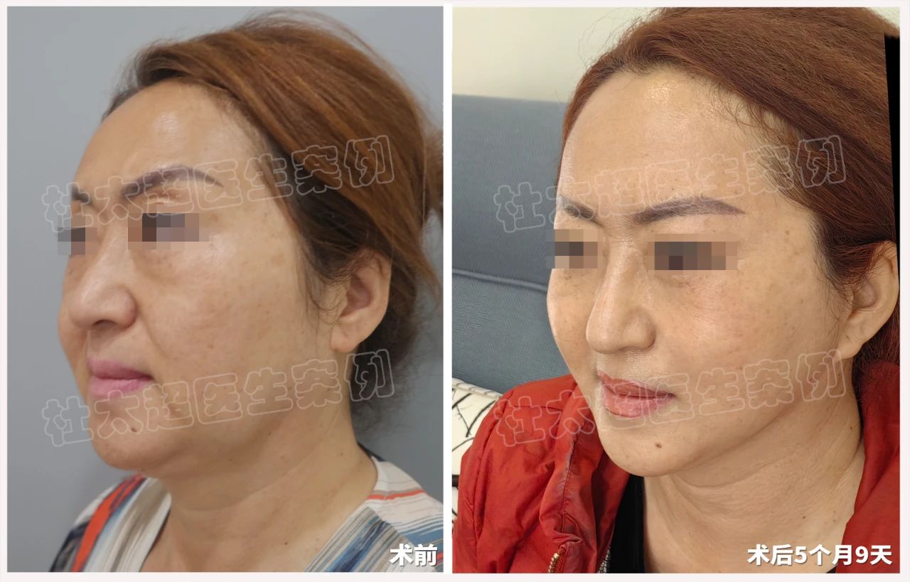 五个月蜕变：56岁求美者通过拉皮手术打造紧致年轻态！