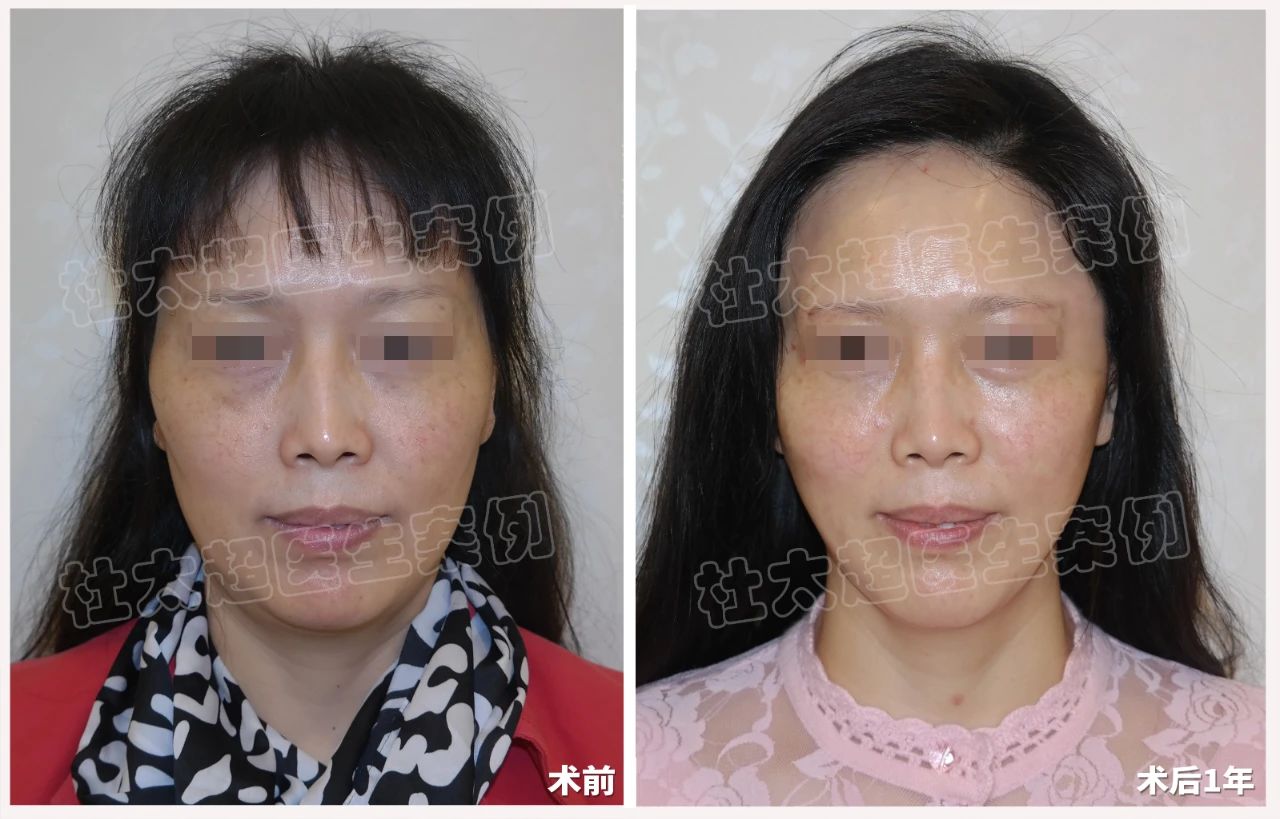 拉皮真那么可怕？56岁女士拉皮手术成功逆袭！术后一年对比