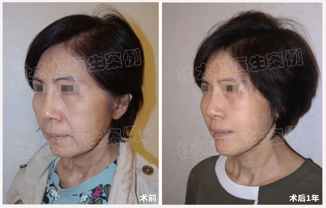 翻转岁月：64岁女士拉皮手术术后1年前后对比！