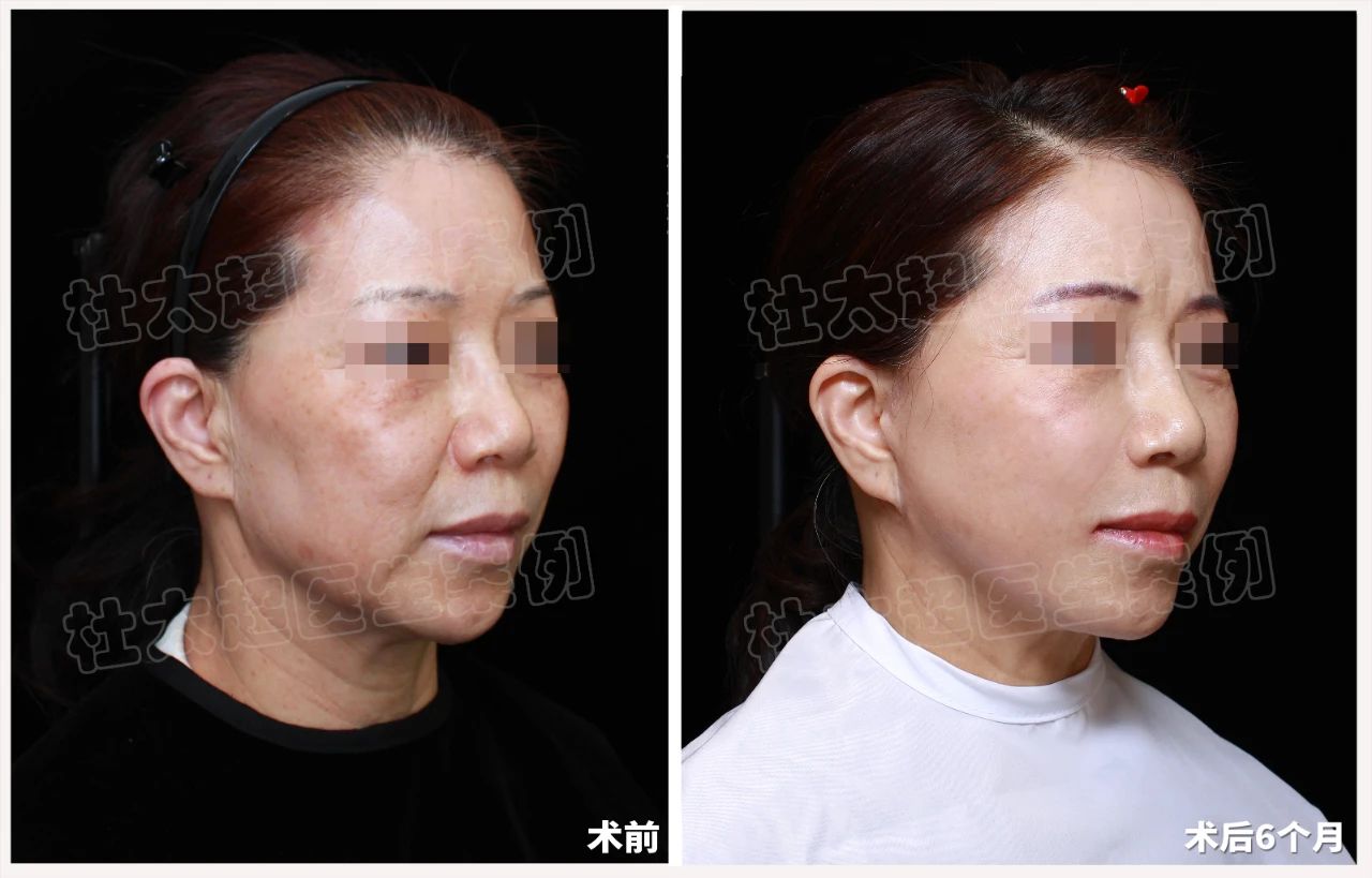 拉皮术适合我吗？看完这位55岁女士的变化再决定！