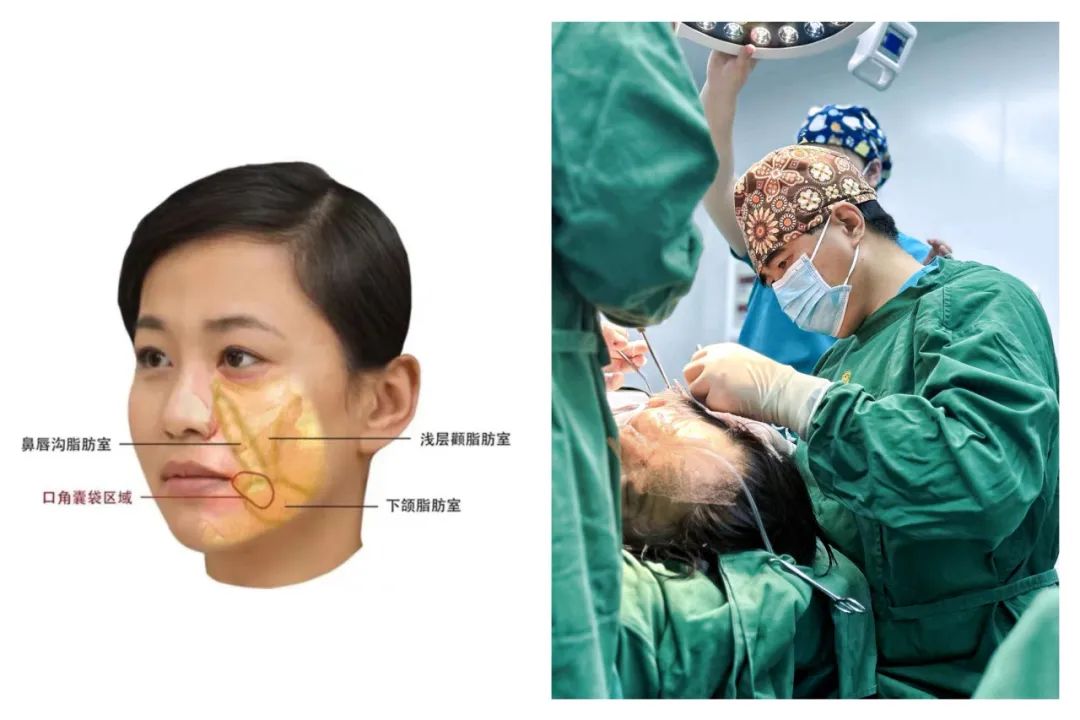 “面部馒化”究竟是如何产生的？拉皮手术可以有效改善吗？