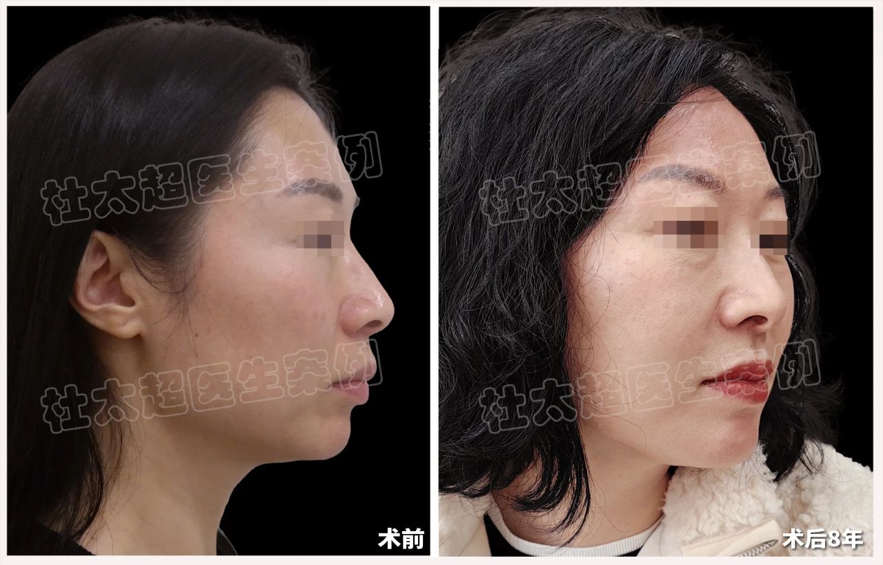 8年前的“泼天富贵”她算是接下了！拉皮手术真的有那么好吗？揭秘‘劲爆’到不行！