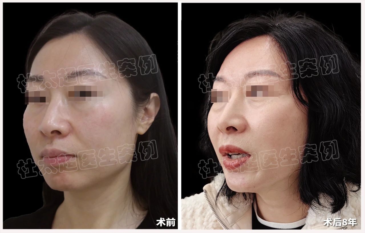 8年前的“泼天富贵”她算是接下了！拉皮手术真的有那么好吗？揭秘‘劲爆’到不行！
