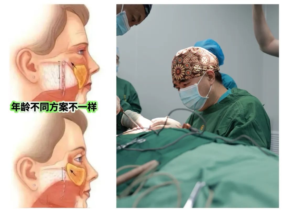拉皮手术后必须包扎吗？能不能不包扎？