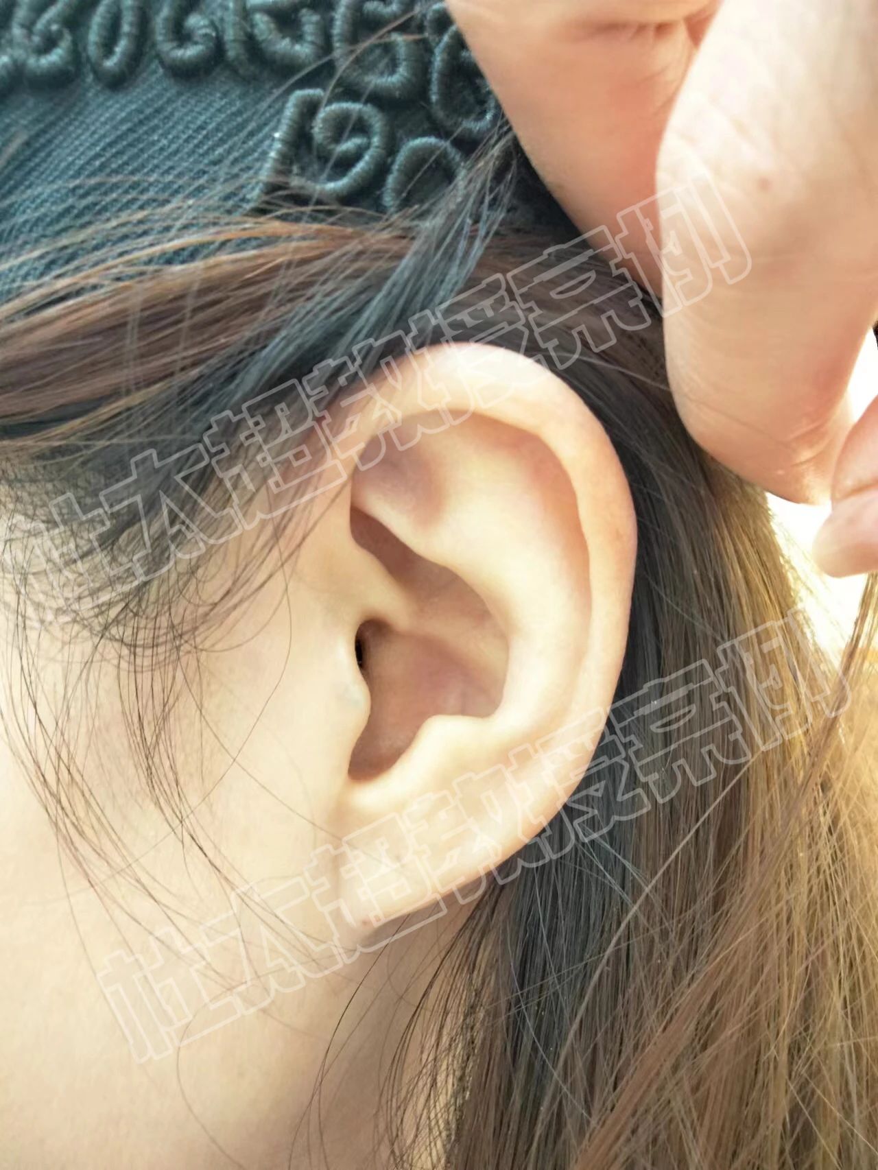 拉皮手术就该悄无声息，告别大刀阔斧的“蜈蚣疤”！