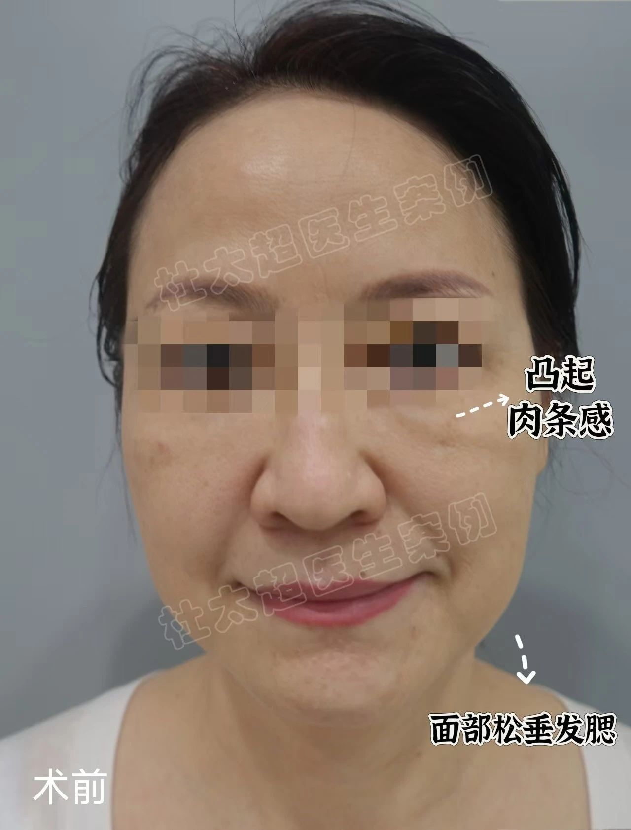 从“沧桑大妈”到“逆龄女神”，拉皮手术不可告人的秘密！