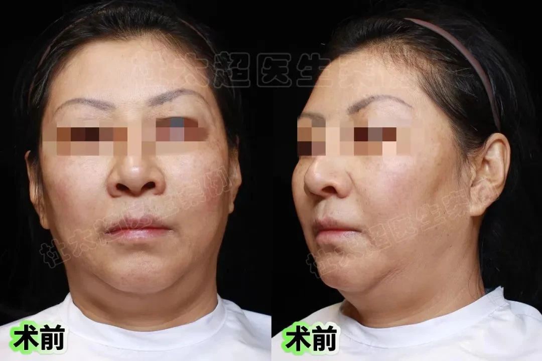 什么叫成功的拉皮手术？美丽，是勇敢者的奖赏！