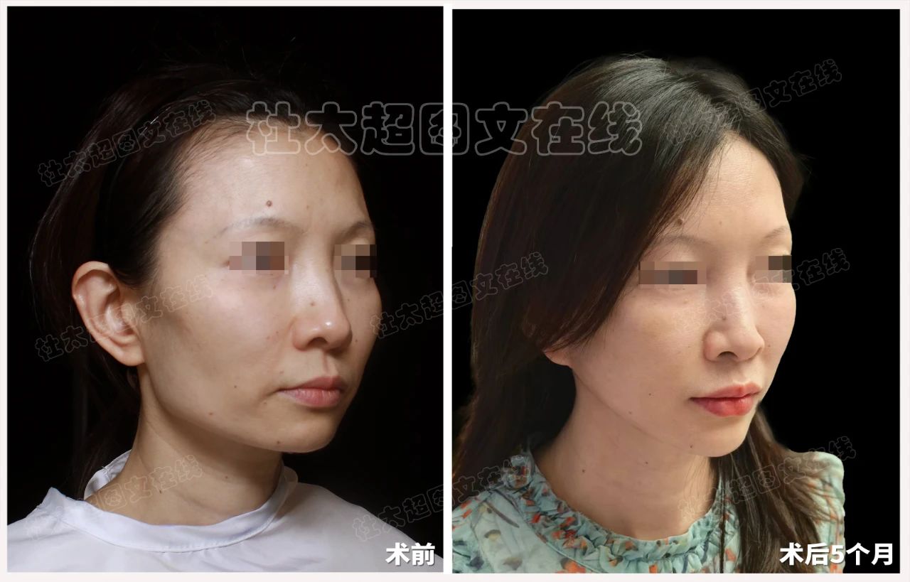 46岁整形成瘾？再次选择拉皮手术，是最后的雕琢还是美丽的重启？