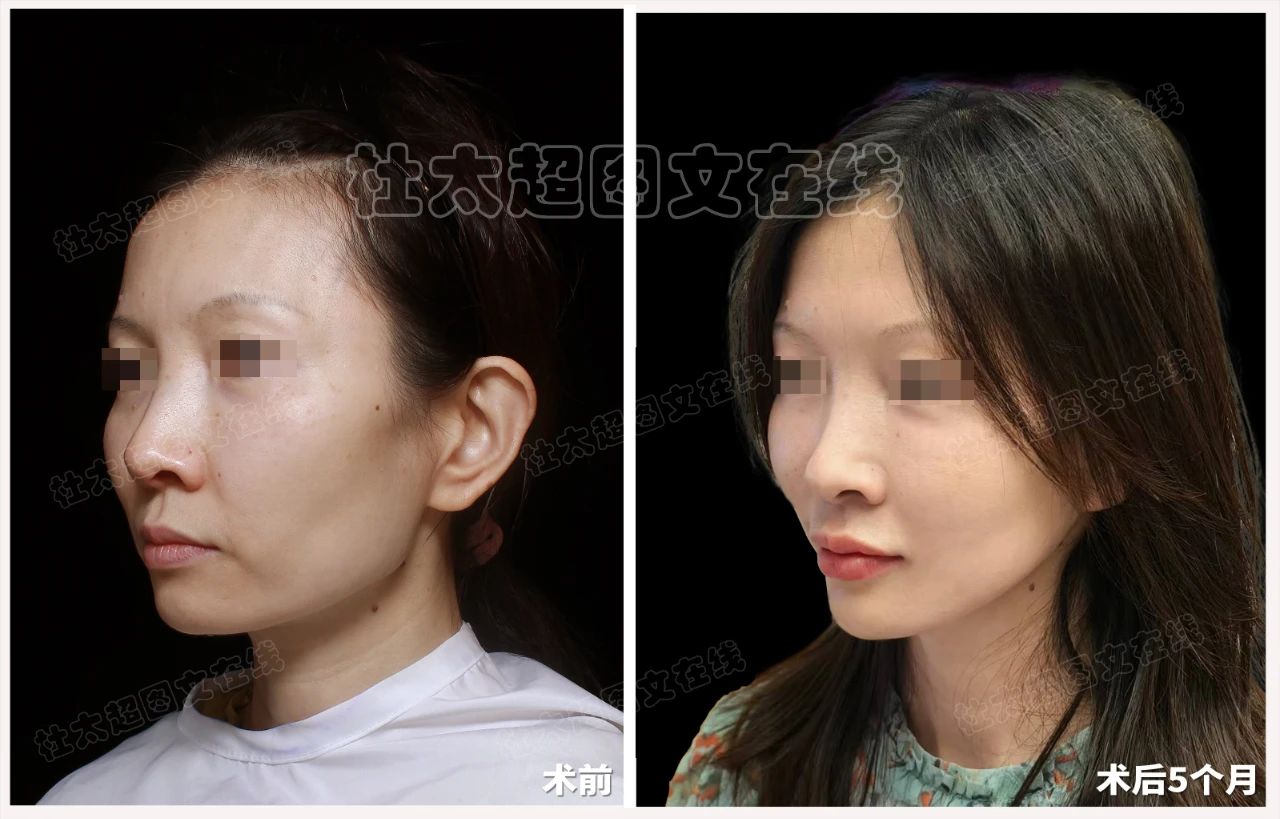 46岁整形成瘾？再次选择拉皮手术，是最后的雕琢还是美丽的重启？