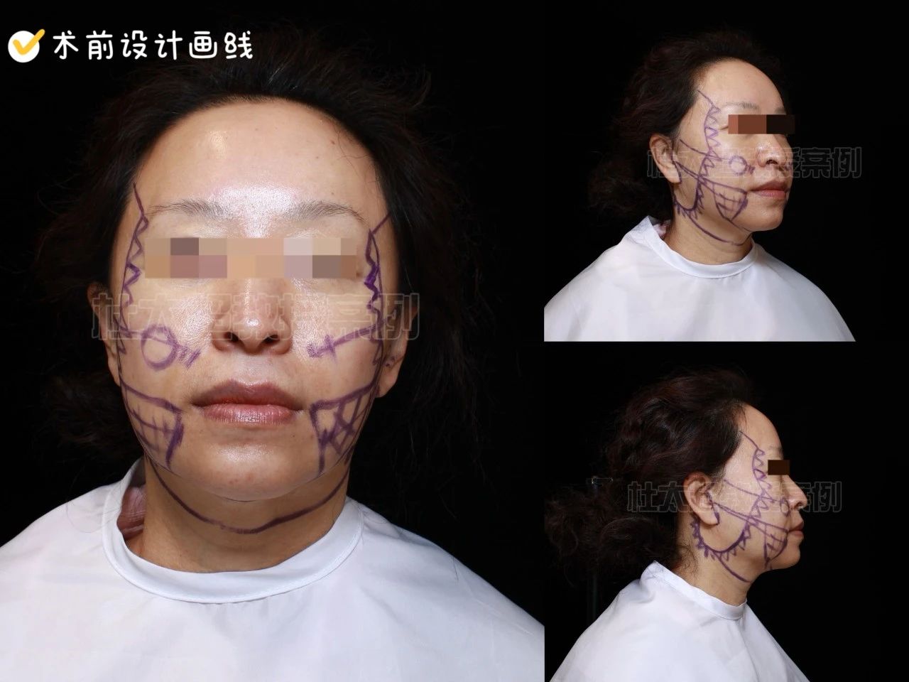 拉皮手术效果怎么样？这不是不要脸，是我追求美的权利！55岁又怎样？