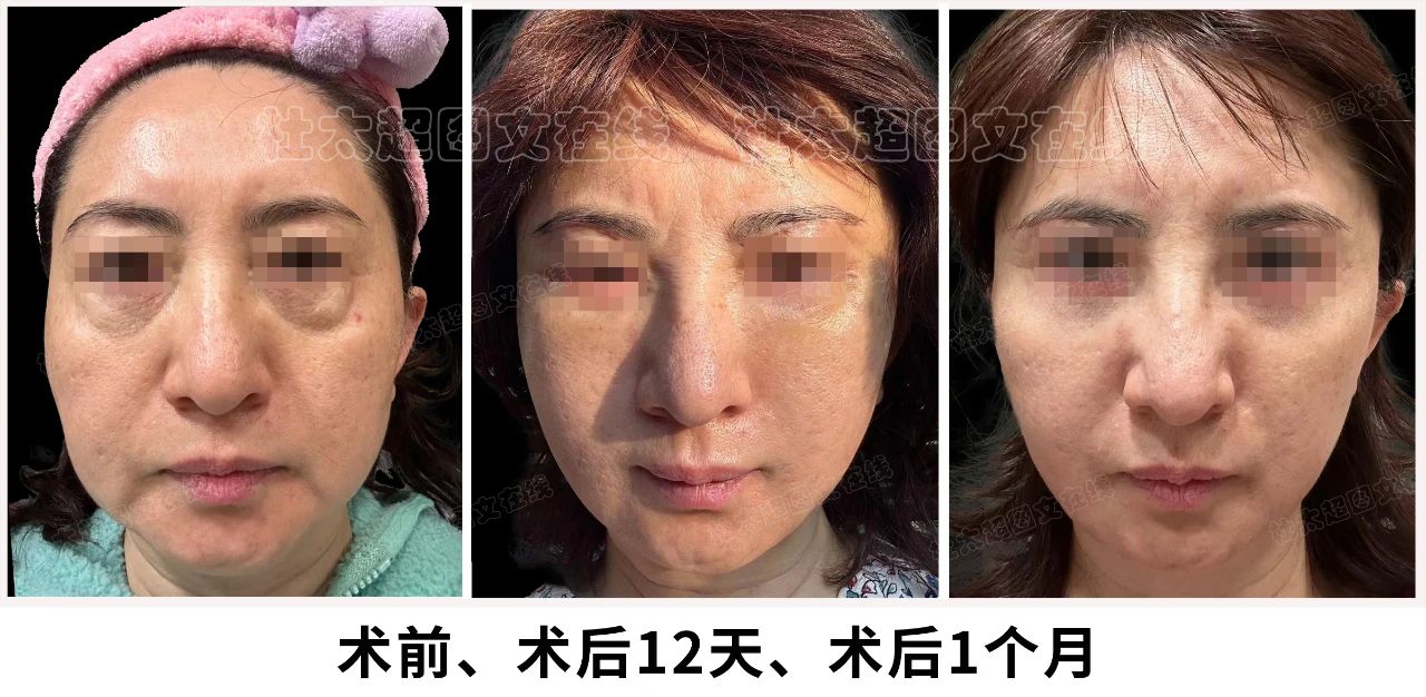 一个成功的拉皮手术应该具备哪些特点和优势呢？