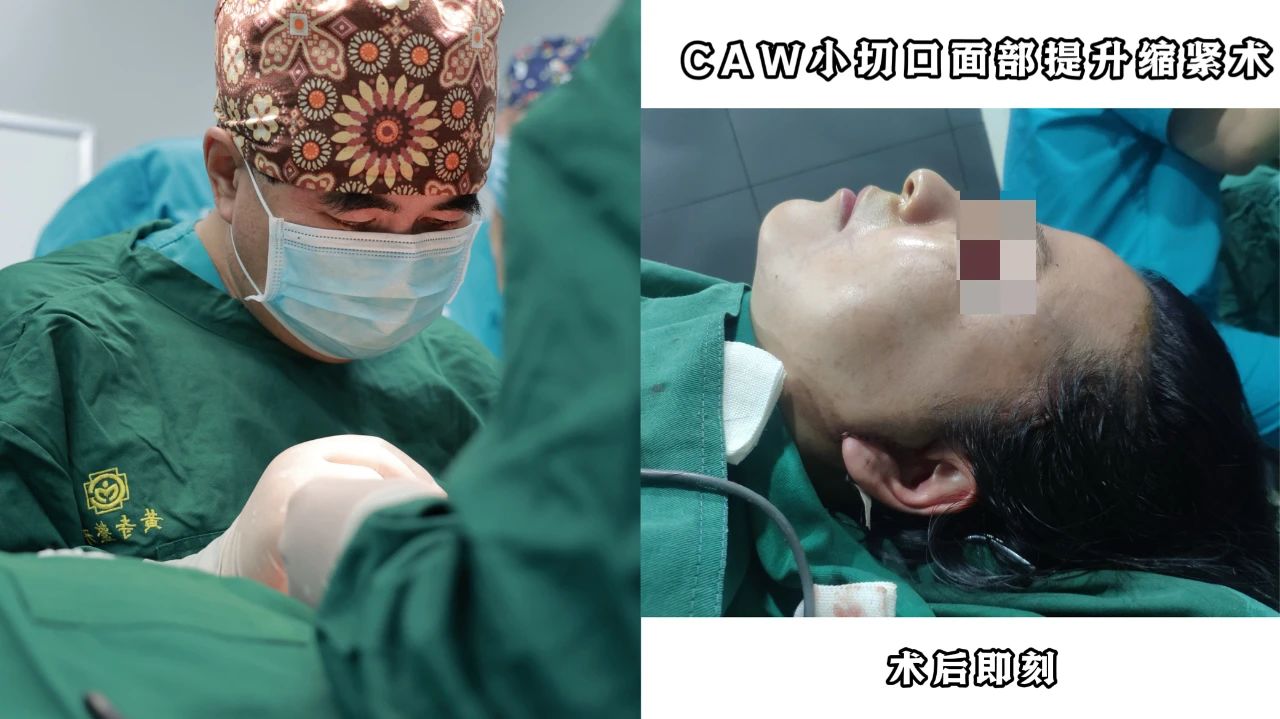 54岁拉皮手术后第四年，这样的效果值吗？真实反馈大曝光......