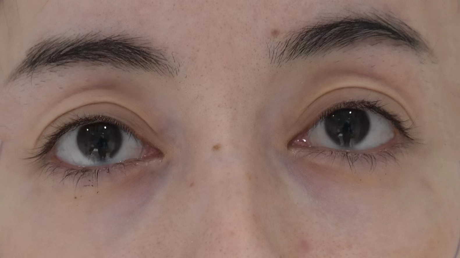 29岁求美者切眉术后恢复过程记录，真实分享