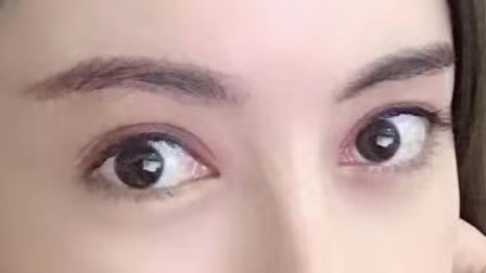 29岁求美者切眉术后恢复过程记录，真实分享