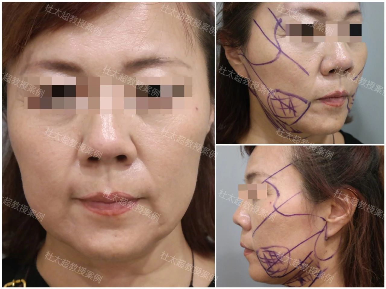 56岁力排众议怒做拉皮手术！谁说50+的女人不能美！