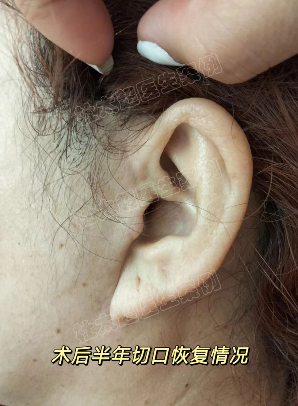 拉皮手术后的疤痕明显吗？