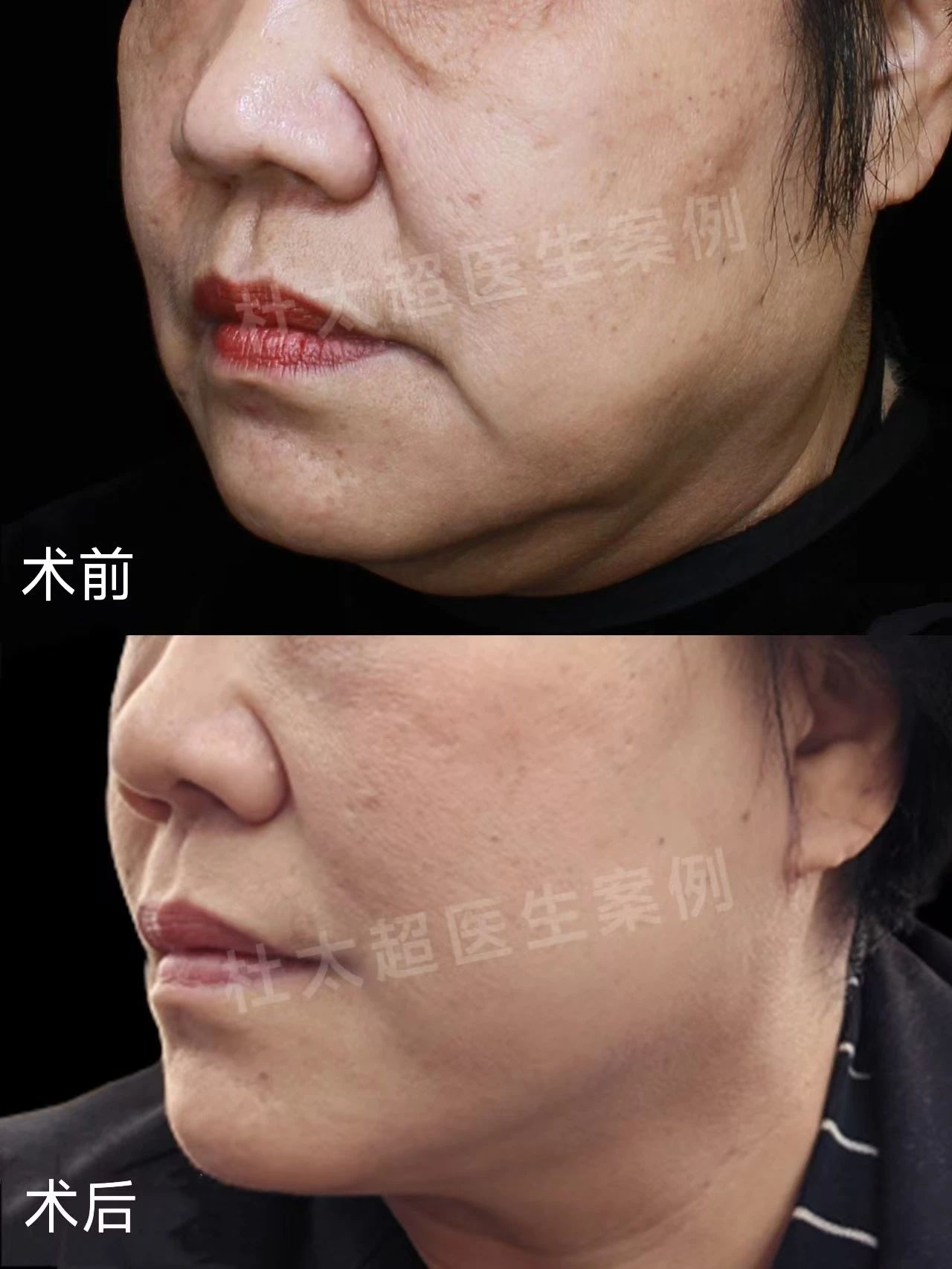 肉肉脸的松垮下垂，医美解决方案何在？