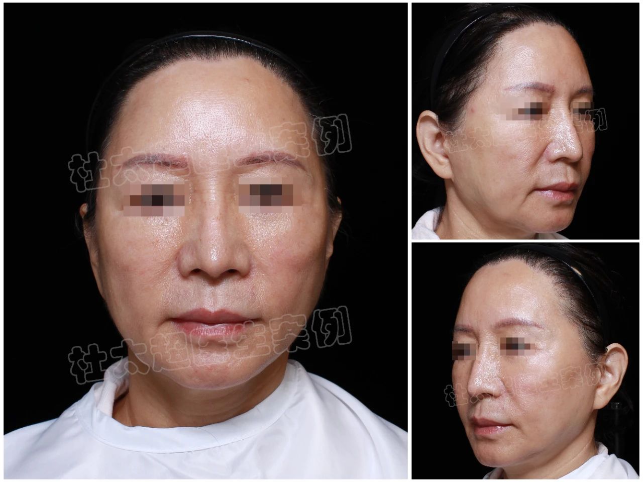 拉皮修复从绝望到重生：我如何飞越万里，在杜太超教授手中找回十年青春
