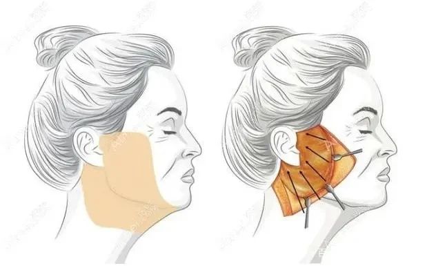 拉皮手术哪有那么多后遗症？找错医生才是“真·后遗症”！揭秘caw小切口面部提升缩紧术的奇迹之处！