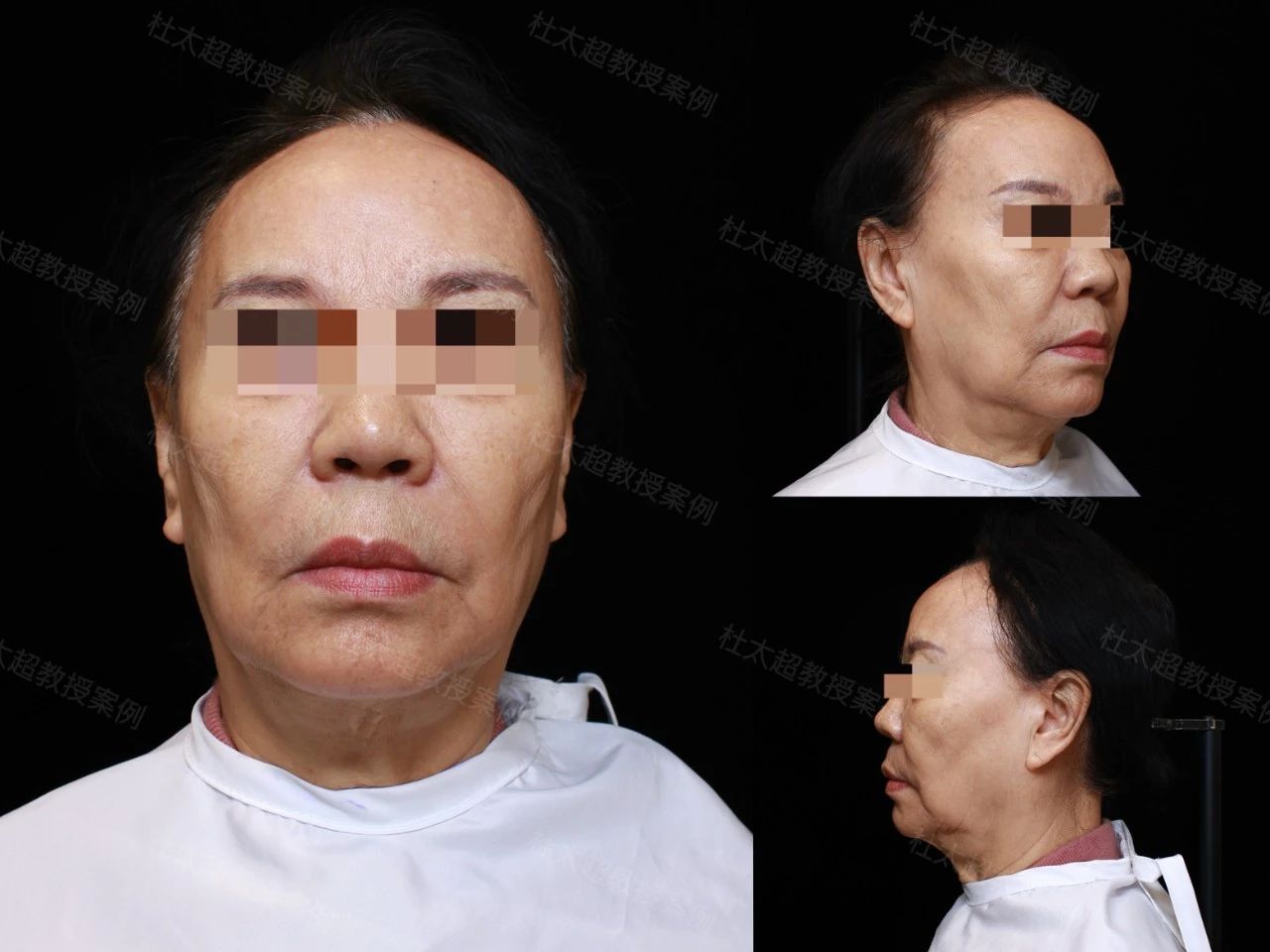本命年能做拉皮手术吗？70岁奶奶告诉你，不惧任何因素，caw小切口面部提升缩紧术，术后6个月美出新高度！