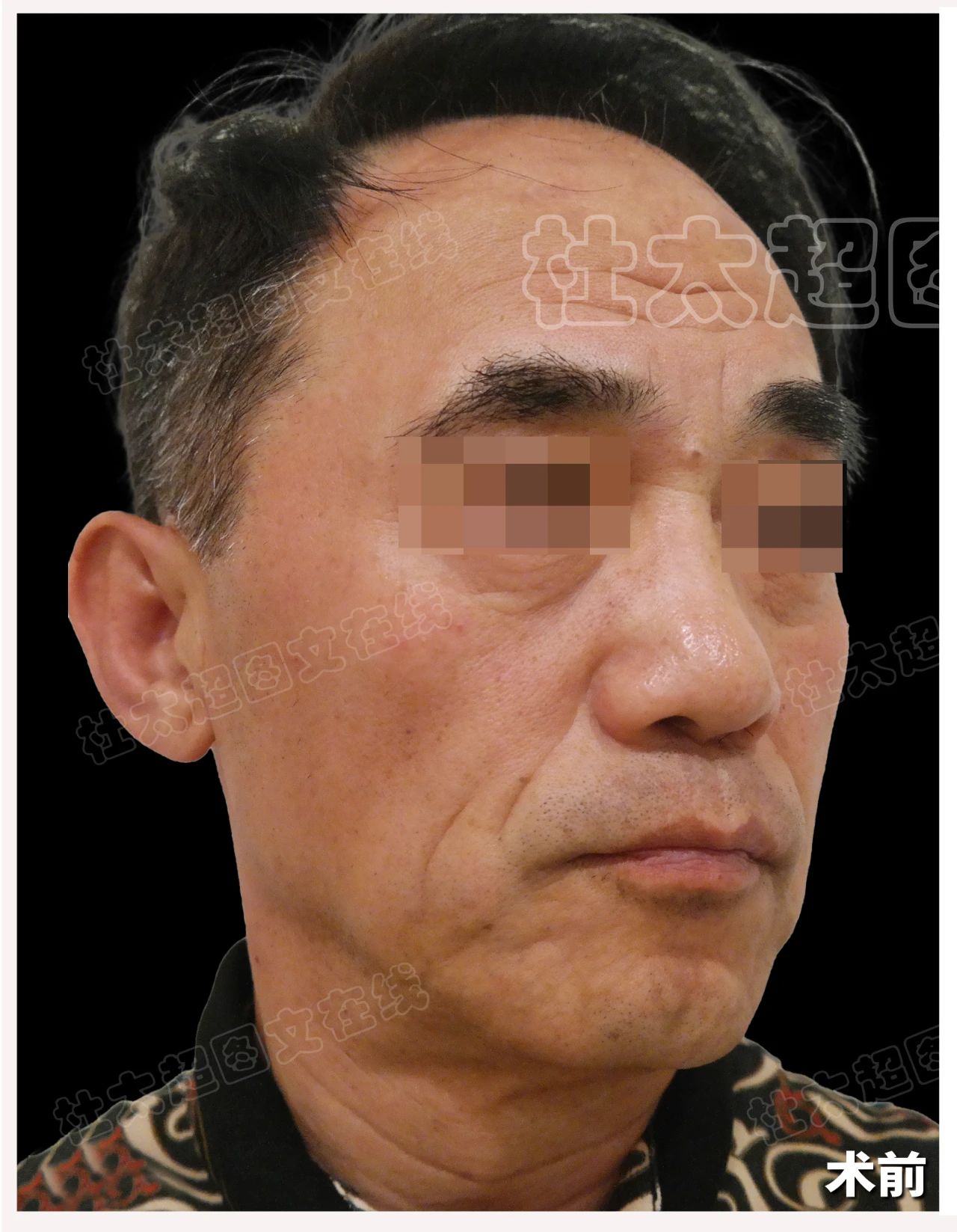 63岁大叔“拉皮逆龄”，挑战同龄刘德华、施瓦辛格的不老神话？