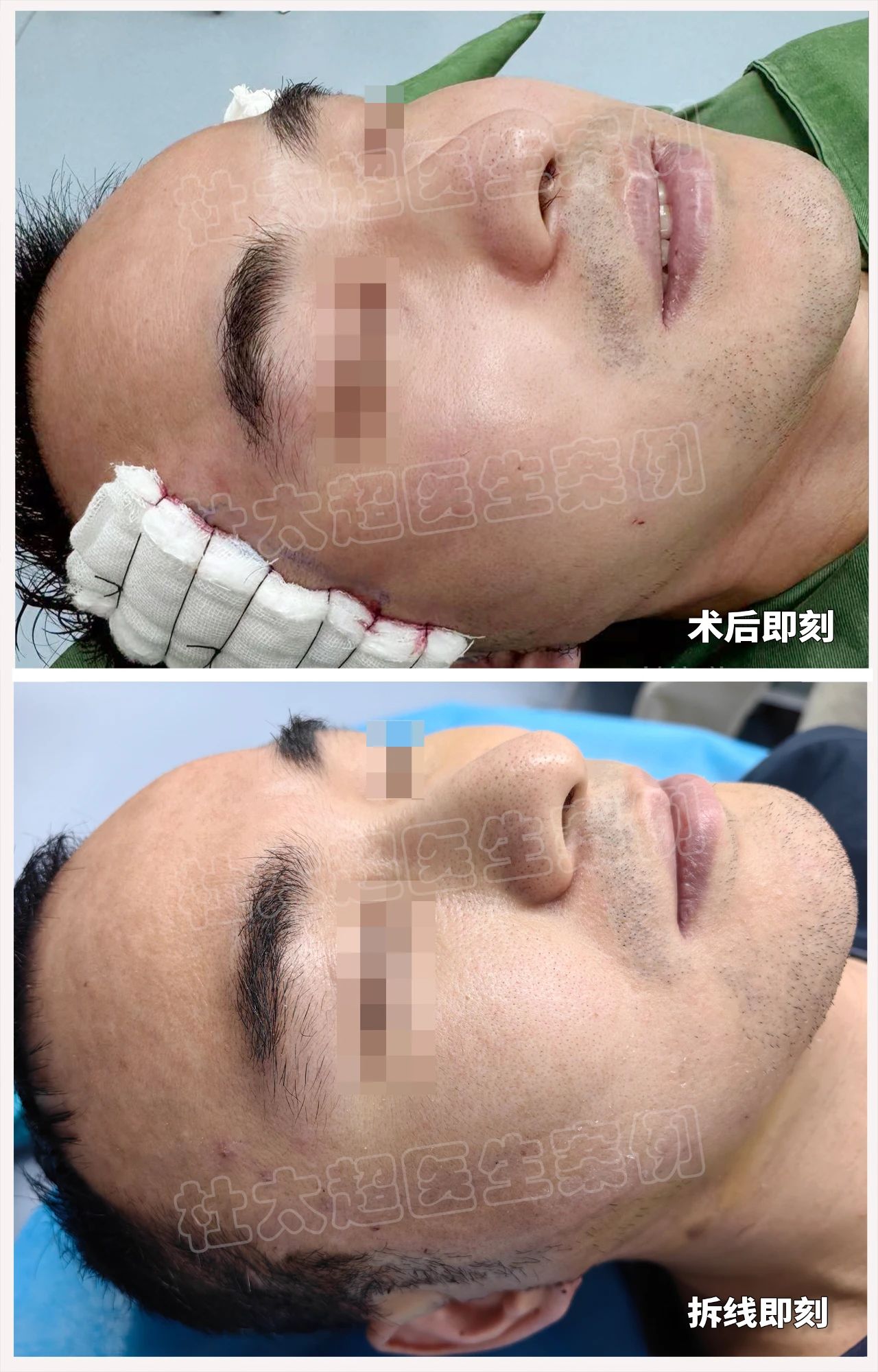 劲爆！男人为了拉皮手术，竟编出这些奇葩理由？真相惊人！