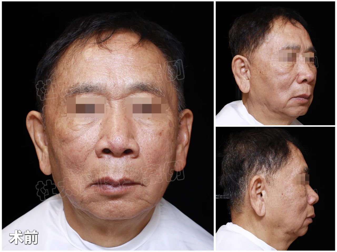 医者之心：见证73岁男士拉皮，美丽与信任的结晶 —— 杜教授手记