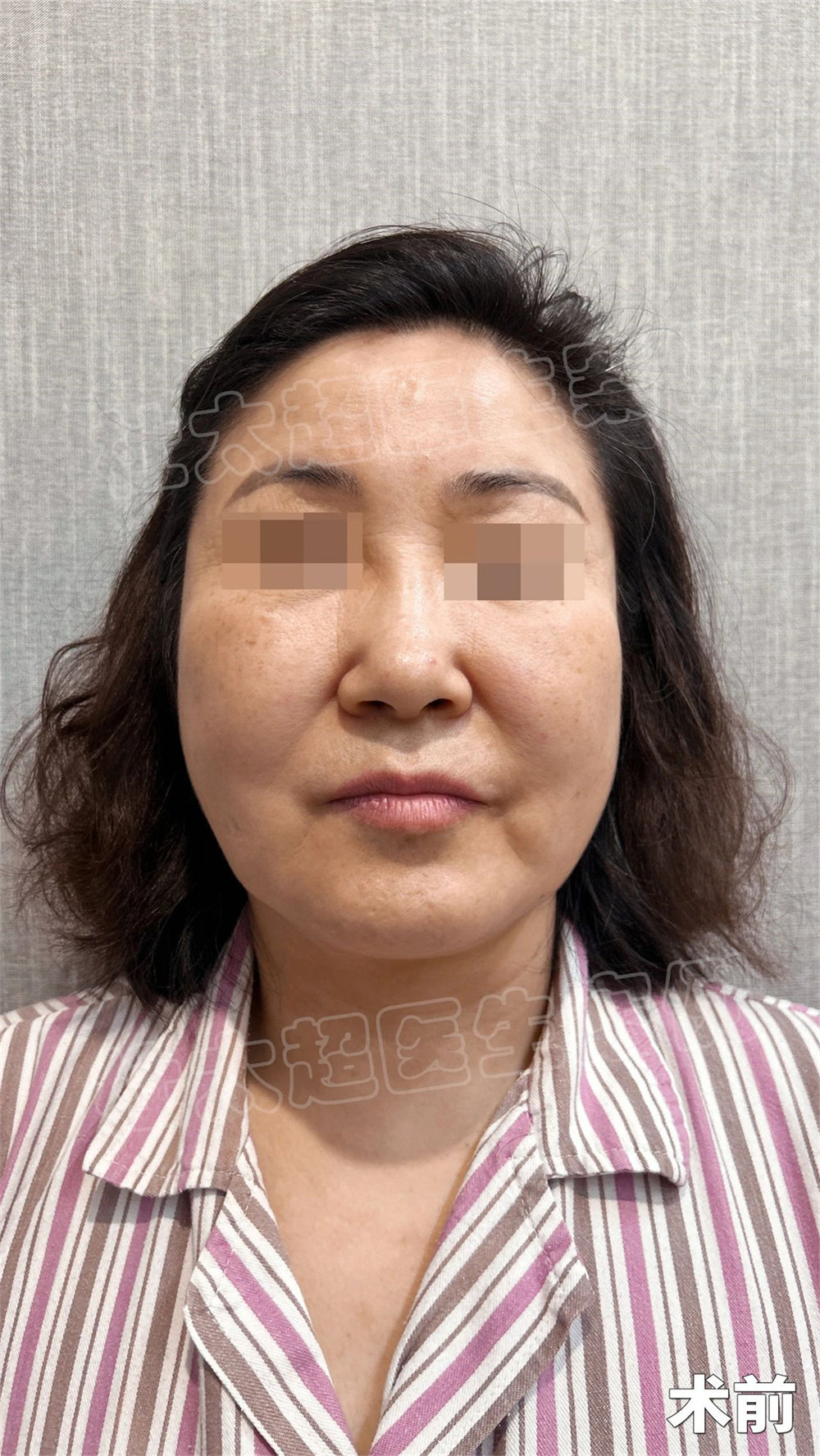 56岁阿姨3小时“换头”，拉皮手术8天后让人惊呼“救命”？