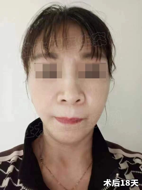 皱纹也怕川渝妹？1次拉皮手术能否让她重返18岁？18天、30天见证奇迹！