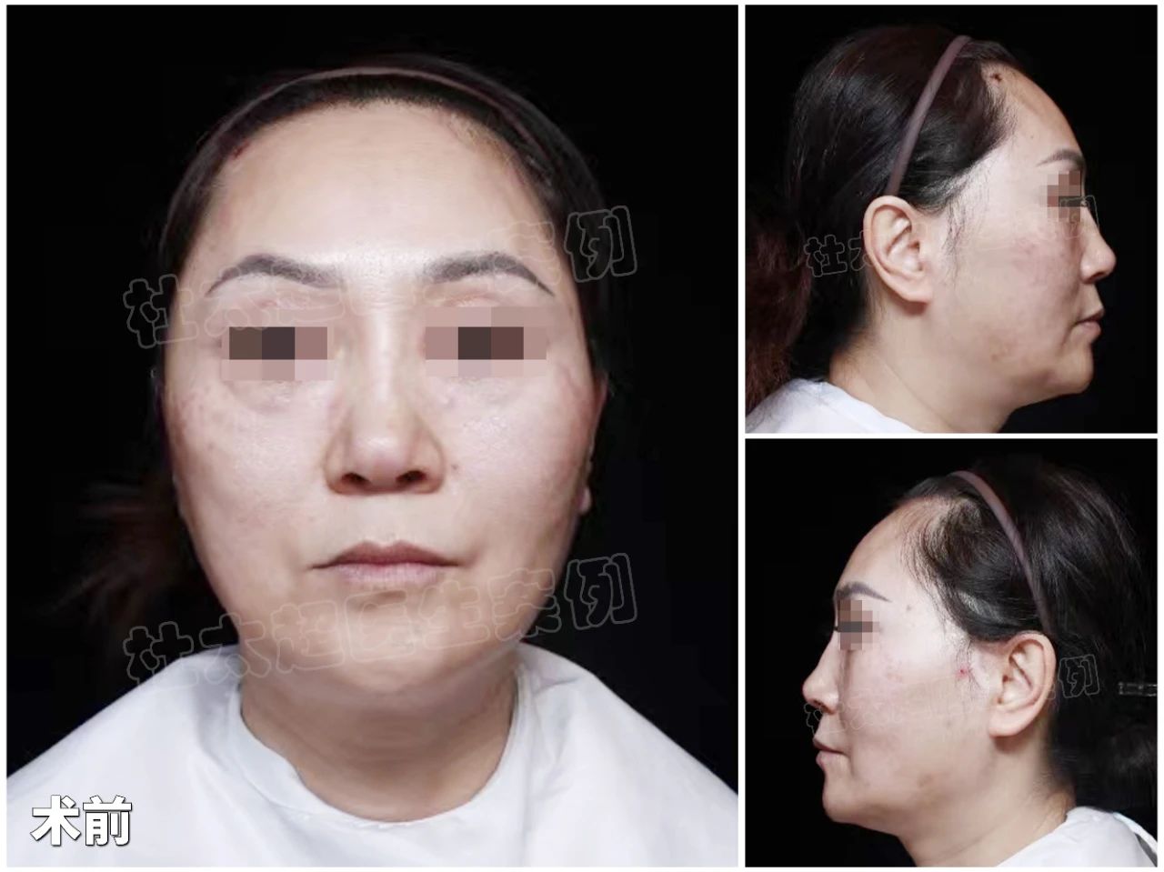 为何她选择二次拉皮？51岁女士的“颠覆性”整形故事，揭秘美丽背后的真相！