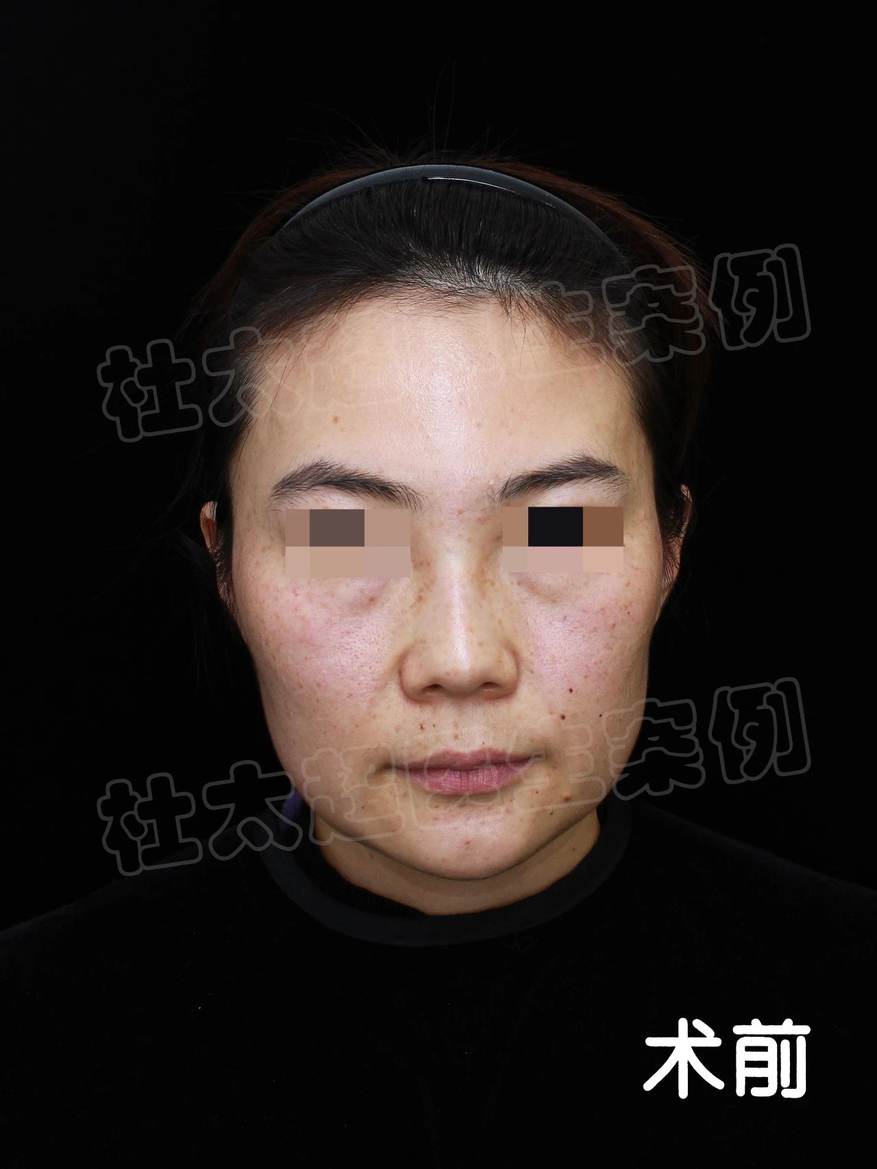 35岁“问题少女”的16天拉皮蜕变！1次手术，3个小时打造10年的青春保障！
