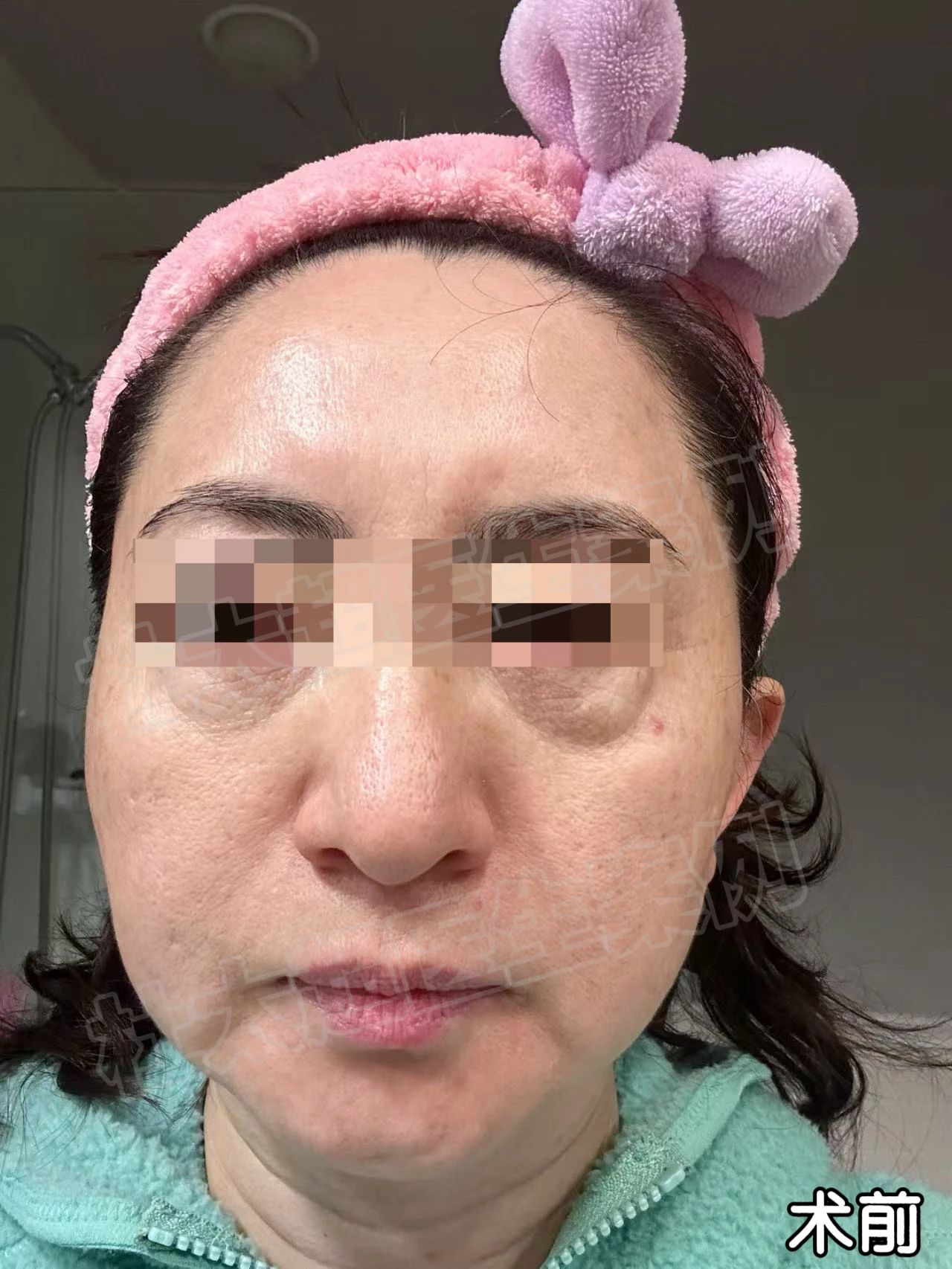 眼袋手术失败，老化问题深？如今3个多小时就能彻底解决？53岁的我决定赌一把！