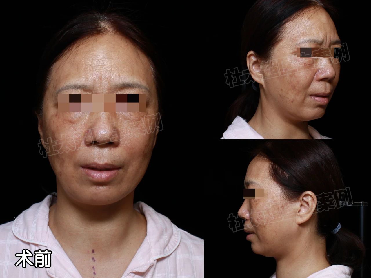 到底什么是年轻？60岁女士用1次拉皮手术逆转20年的时间秘密！