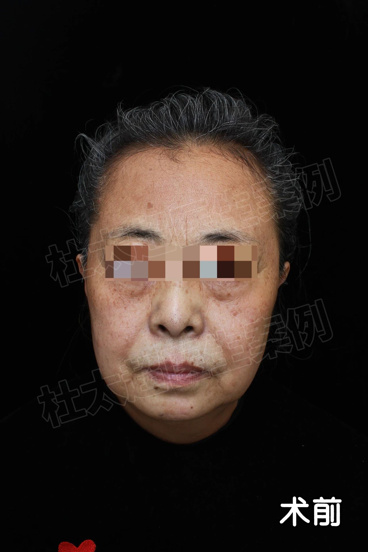 60岁奶奶实话实说：你家的拉皮手术，我就认定了！别的都不考虑！