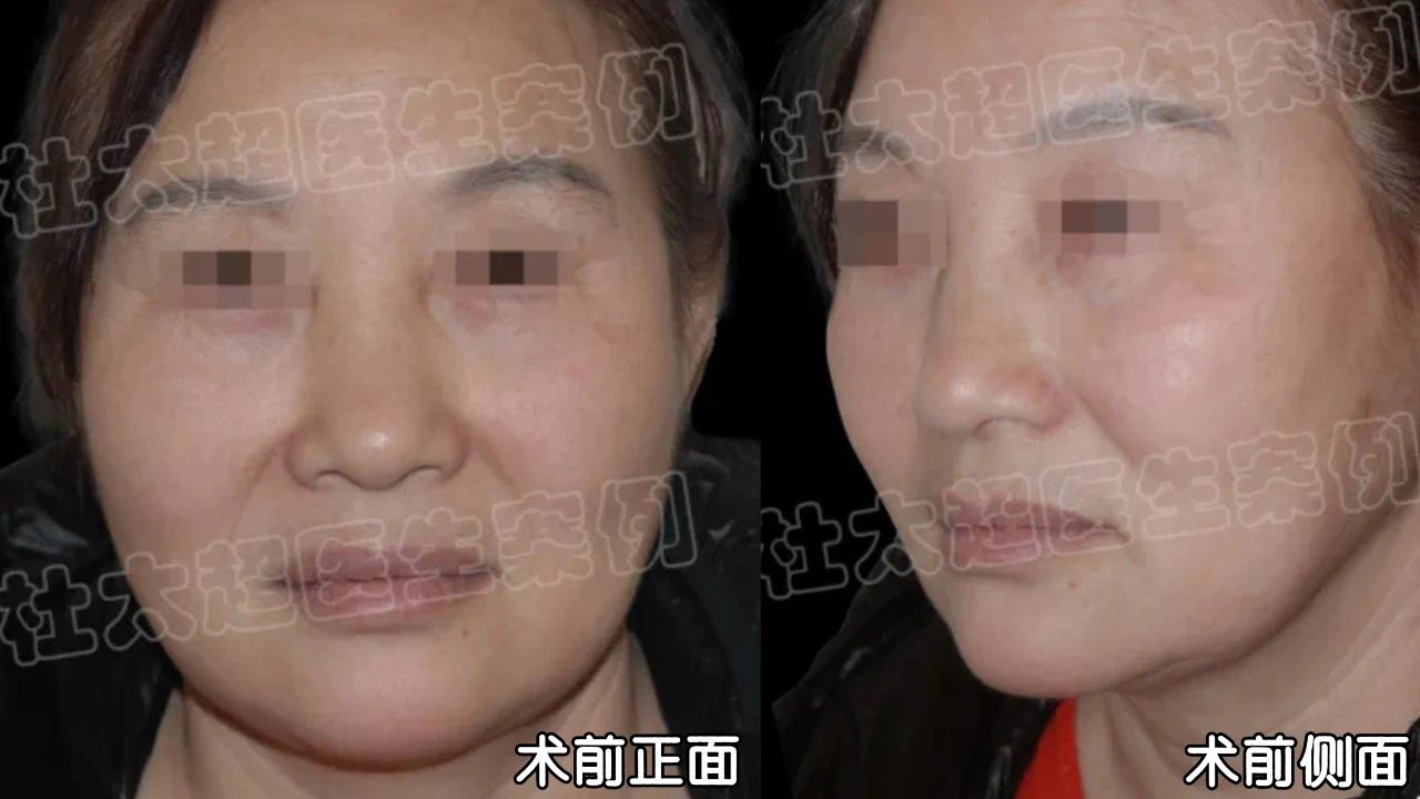 模仿明星微整，却整出“灾难现场”？拉皮手术能否带来重生希望？