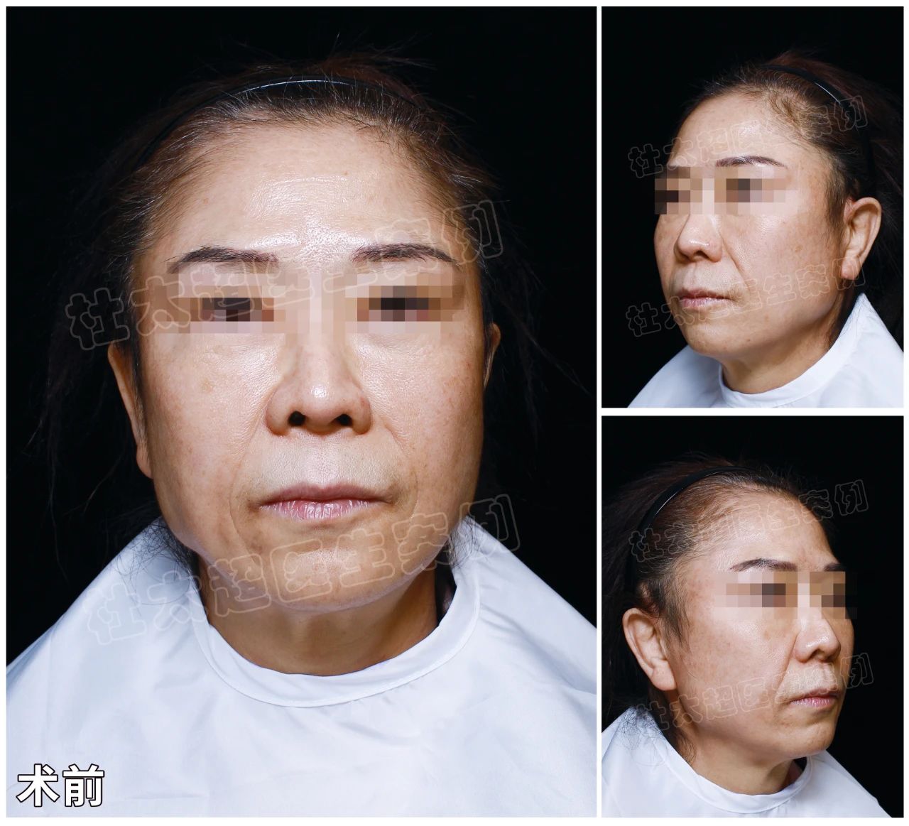 这拉皮手术，我“非得试试”！3小时后减少10年皱纹？效果让我自己都惊讶！
