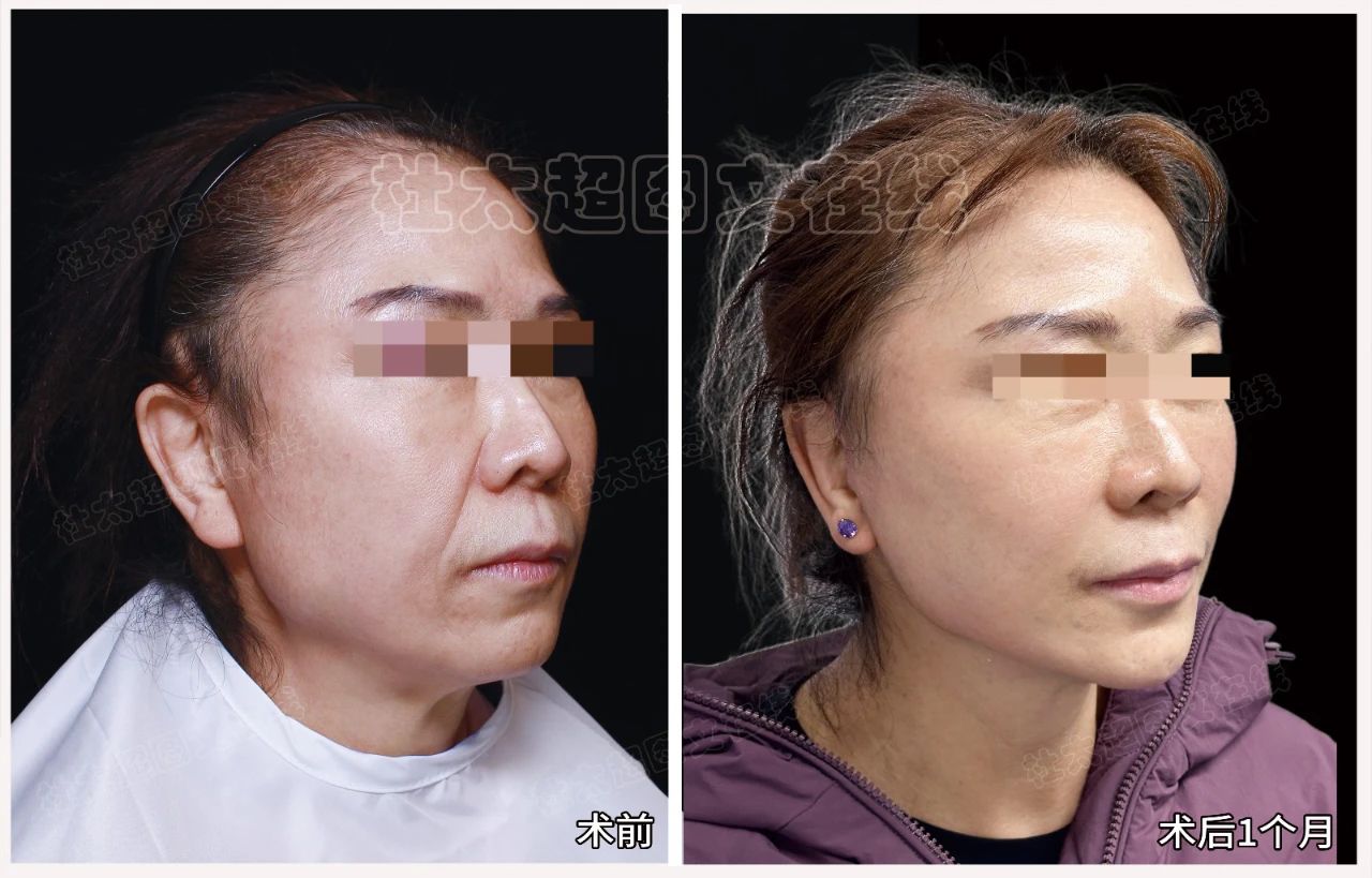 这拉皮手术，我“非得试试”！3小时后减少10年皱纹？效果让我自己都惊讶！