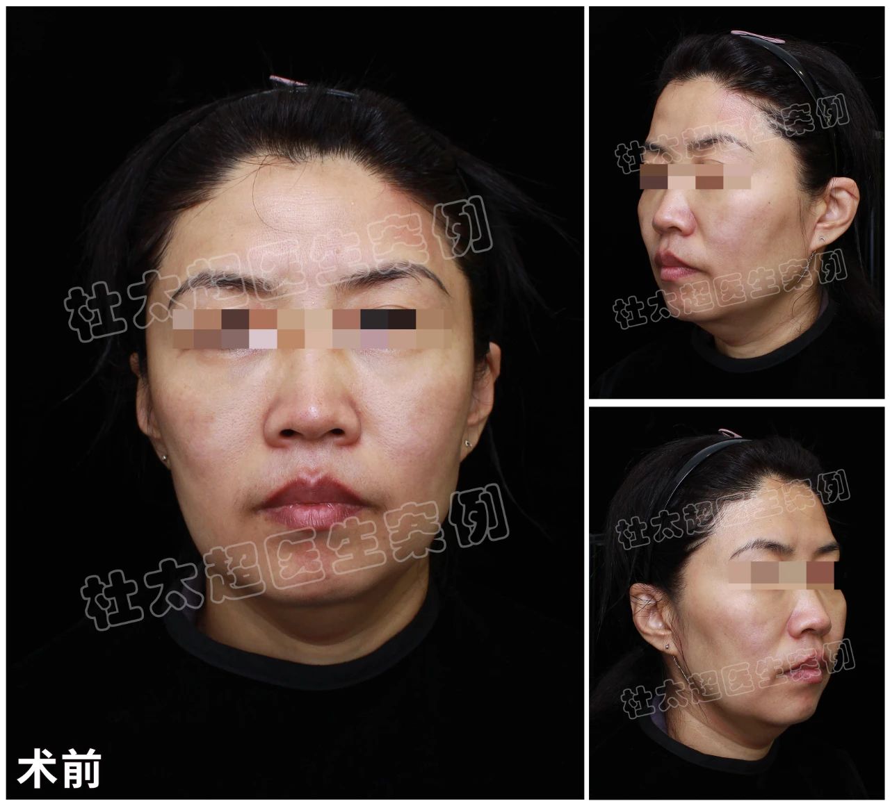 花费10万整形，真的能赚回百万自信吗？拉皮手术前后对比，让你大开眼界！