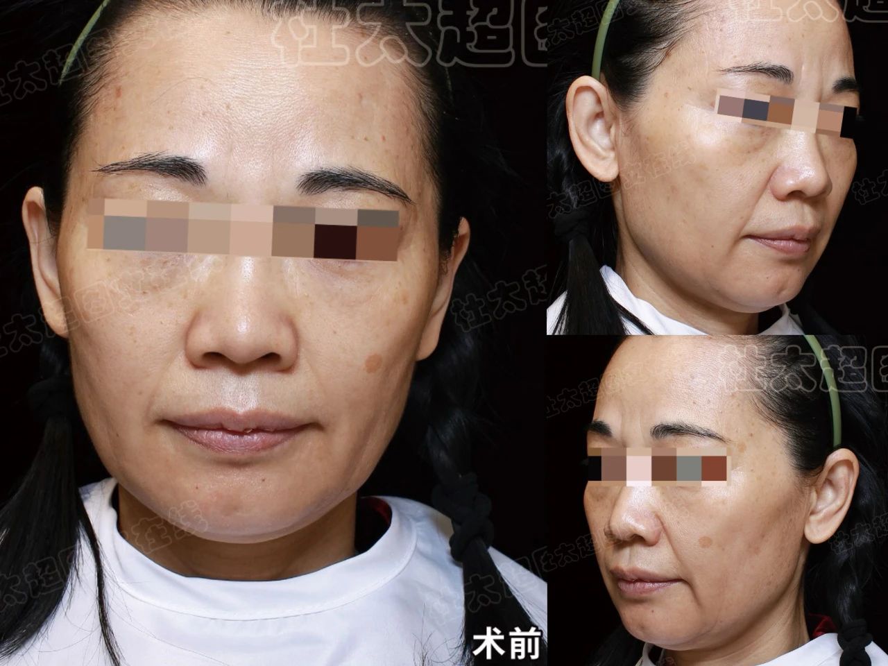 【真相】朋友推荐拉皮手术，背后竟是陷阱？利益驱使？居心叵测！