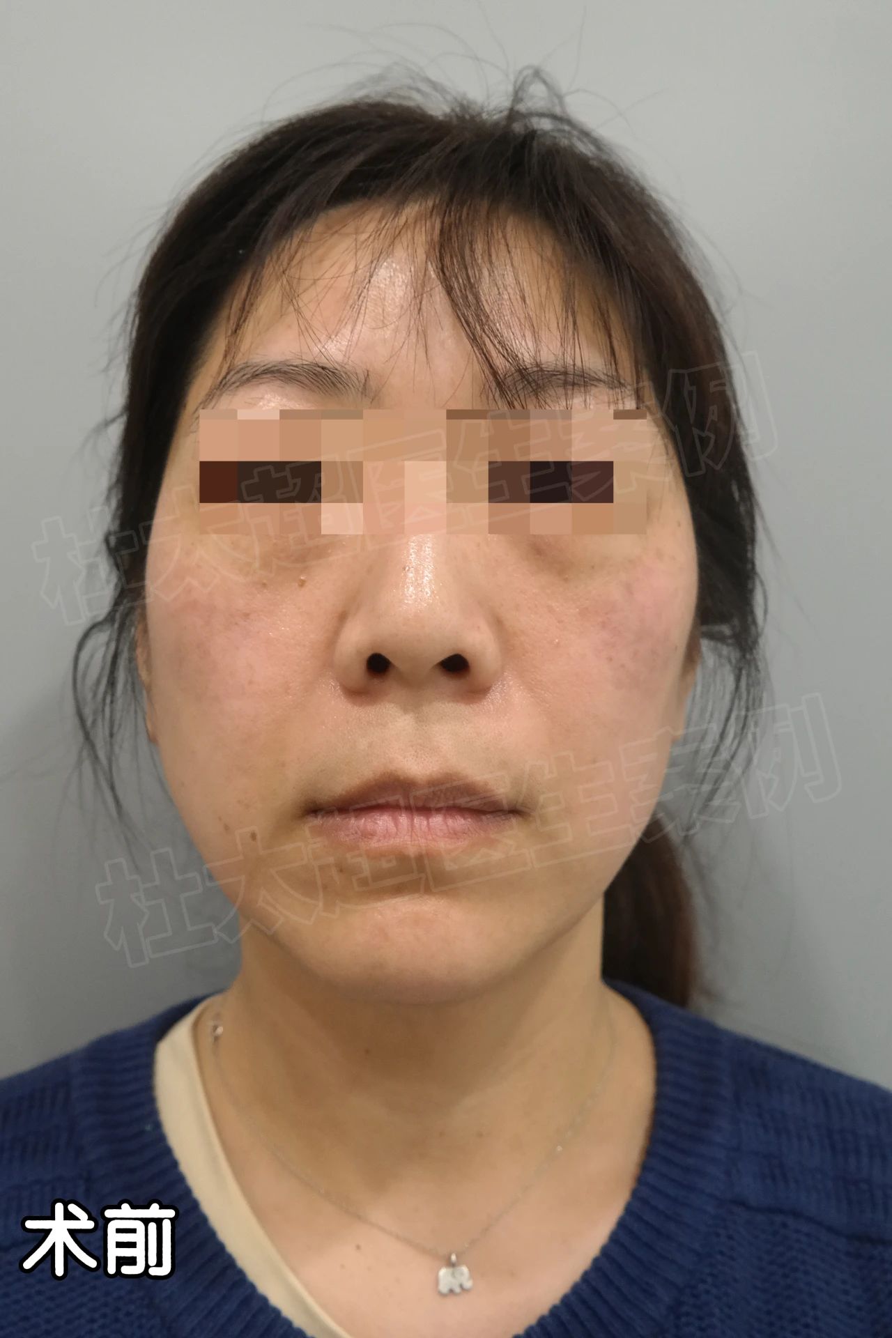 拉皮手术20天后把妈吓坏了！42岁女儿一意孤行，真相令人深思！